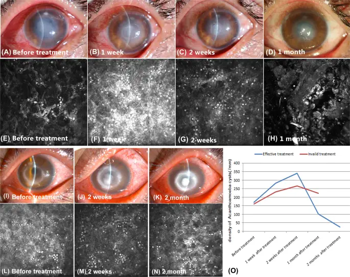 Acanthamoeba keratitis mikroskop