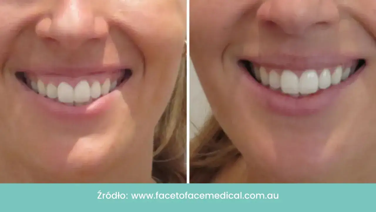 Uśmiech przed i po zabiegu botoksu, który zredukował tzw. gummy smile, odsłaniając piękne zęby.