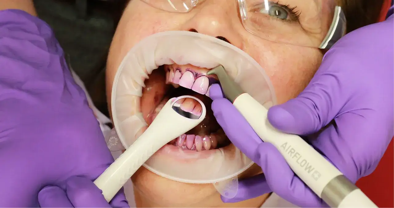 Zabieg stomatologiczny z użyciem odmy powietrznej. Dentysta czyści zęby pacjentki, używając specjalistycznego sprzętu.