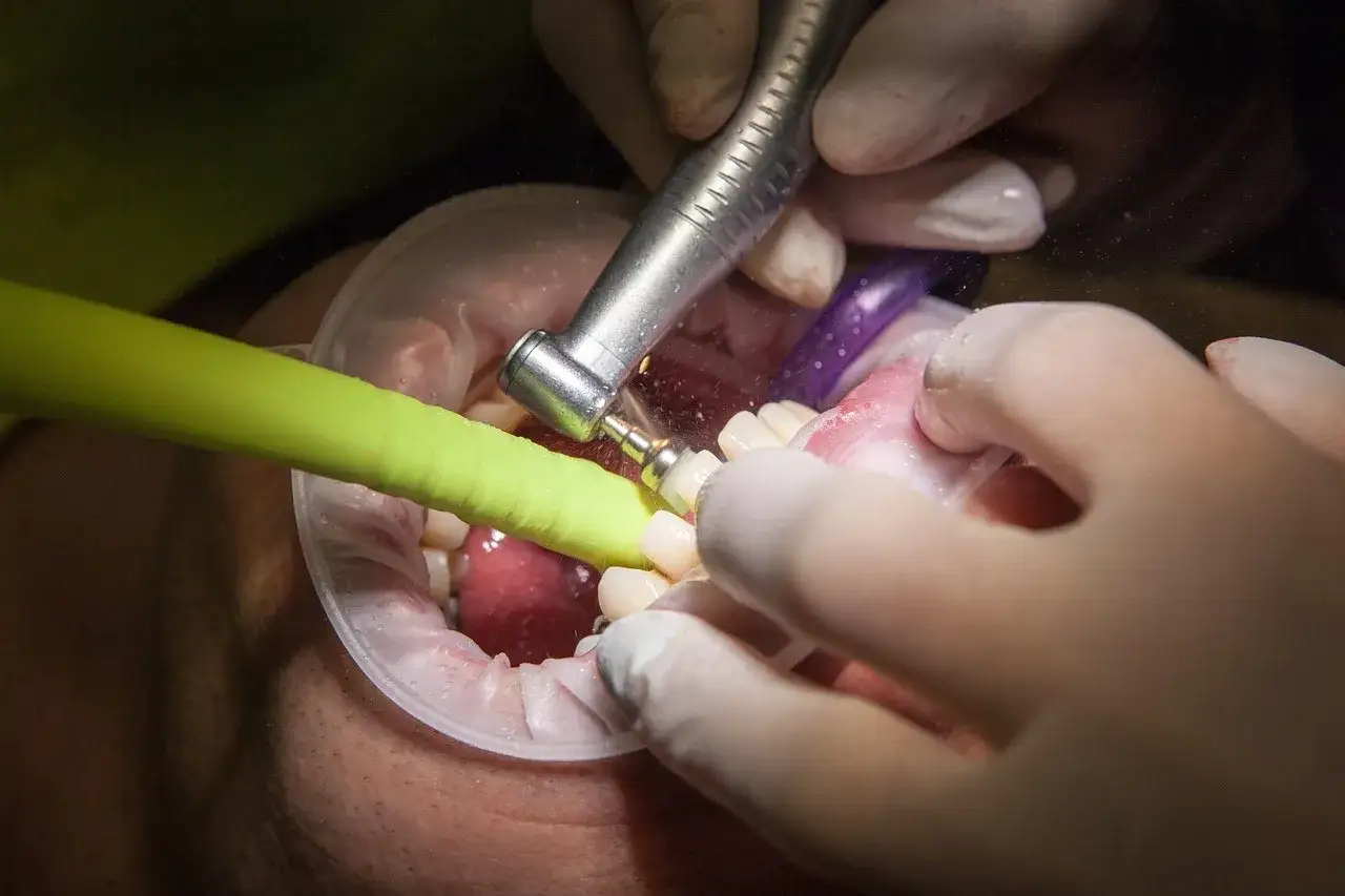Zabieg stomatologiczny: dentyści usuwają ubytki klinowe z zębów pacjenta za pomocą wiertła i ssaka.