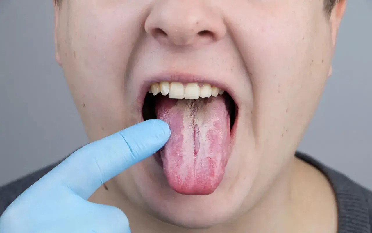 Lingua con patina biancastra e secca, un possibile sintomo di diabete. La bocca secca è un segnale da non sottovalutare.