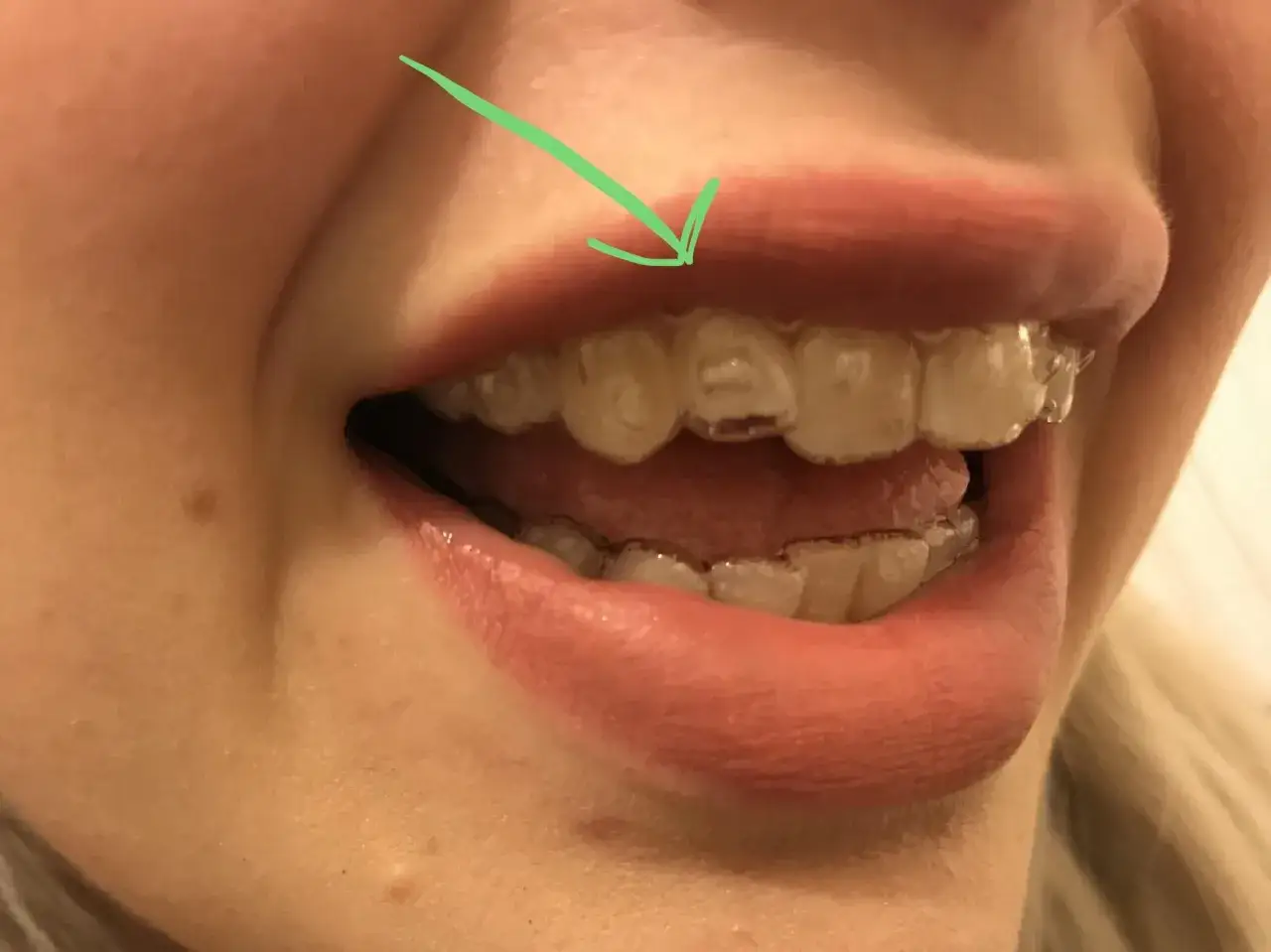 Flecha verde se&ntilde;ala un diente donde el **invisalign no encaja**. Se ven los alineadores transparentes en los dientes.