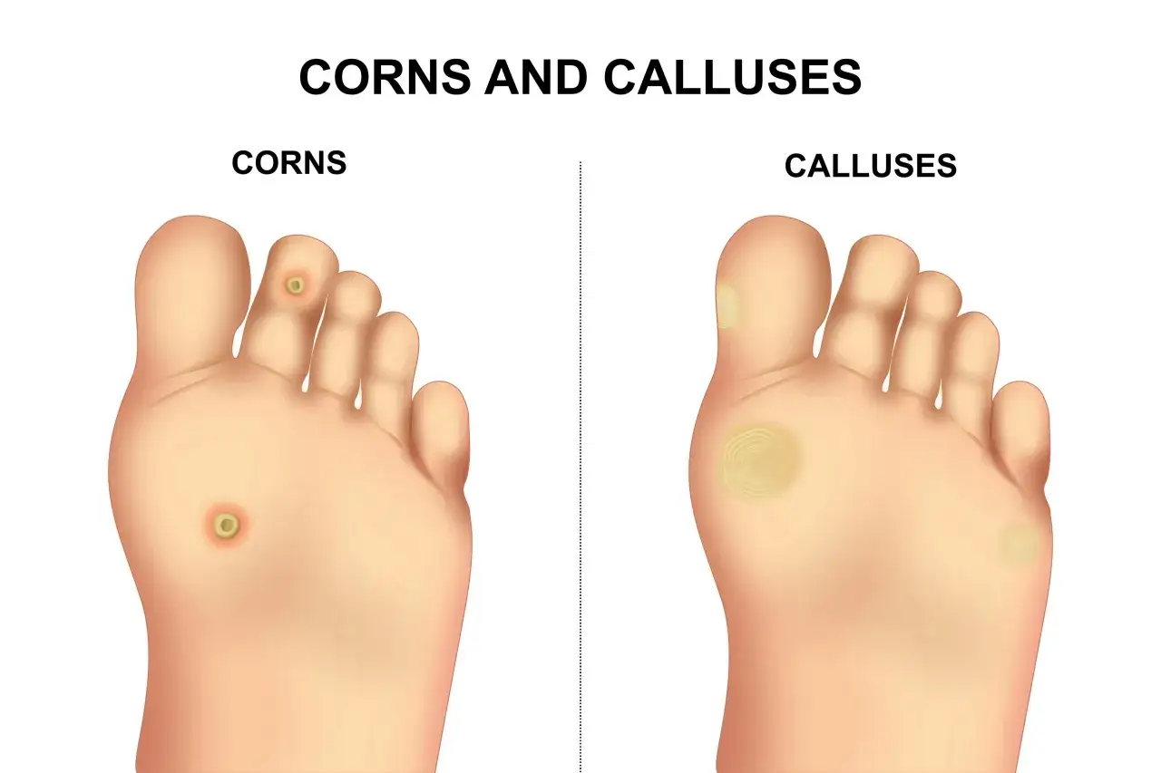 Illustration comparant les cors et les callosit&eacute;s sur un pied. Un cor est une petite zone dure sur un orteil, tandis qu'une callosit&eacute; est une zone plus large et plus &eacute;paisse sur la plante du pied.