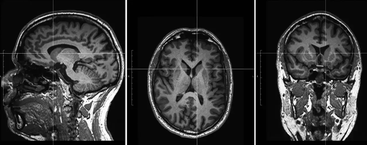 Drei MRT-Aufnahmen des Kopfes: Sagittal, axial und koronar. Sie zeigen die detaillierte Anatomie des Gehirns und helfen bei der Unterscheidung zwischen CT und MRT Kopf.