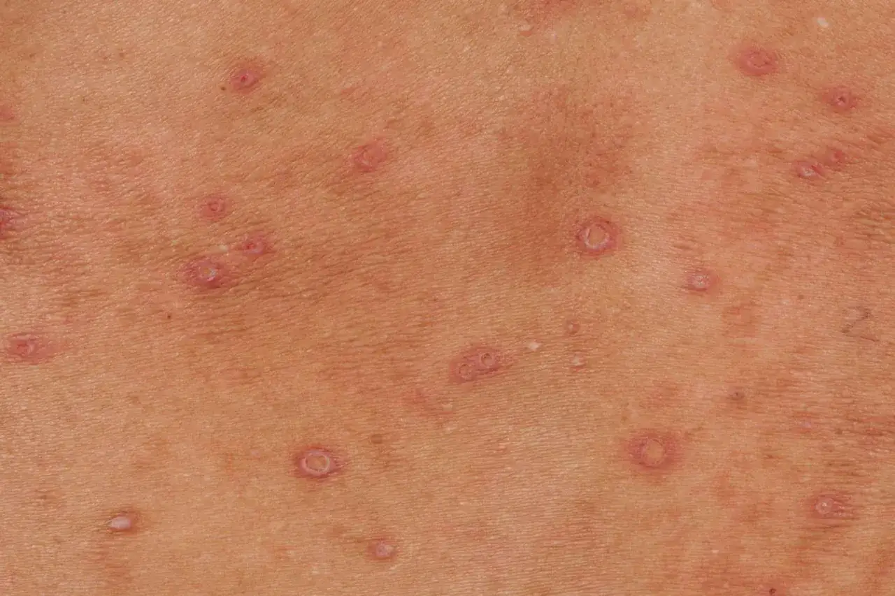 Zmiany sk&oacute;rne, kt&oacute;re mogą być objawami HIV, widoczne jako liczne, drobne, zaczerwienione grudki na sk&oacute;rze.