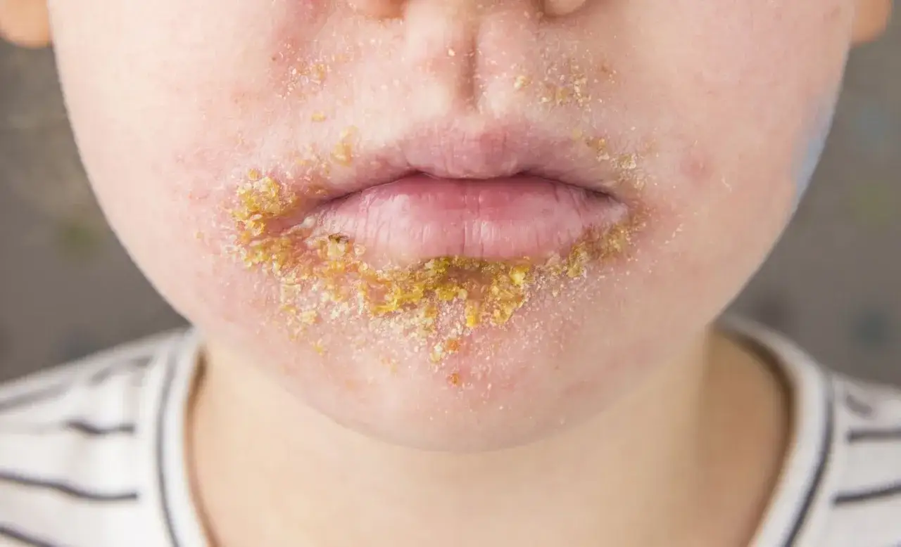 Gros plan sur la bouche d'un enfant pr&eacute;sentant une dartre sur la peau, avec des cro&ucirc;tes jaun&acirc;tres autour des l&egrave;vres.