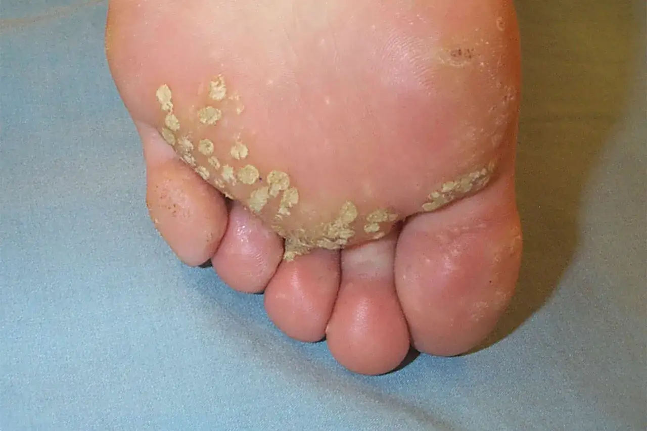 Pied avec plusieurs verrues plantaires. Recherche d'un verrue plantaire traitement naturel pour soulager cette gêne.
