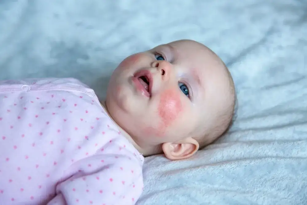 konsultacja lekarska niemowlę alergia