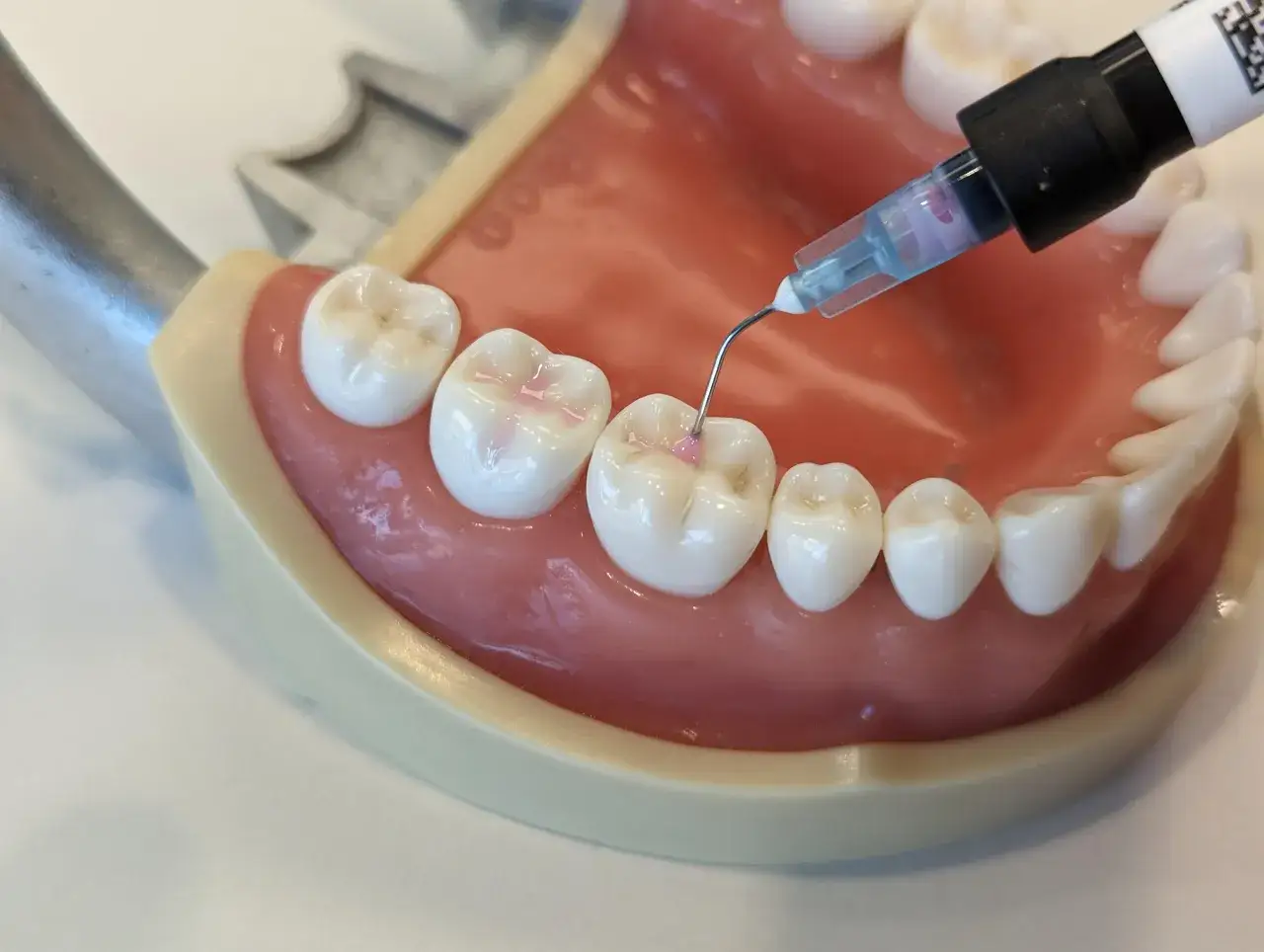 Aplicaci&oacute;n de sellante dental en un modelo de dientes.