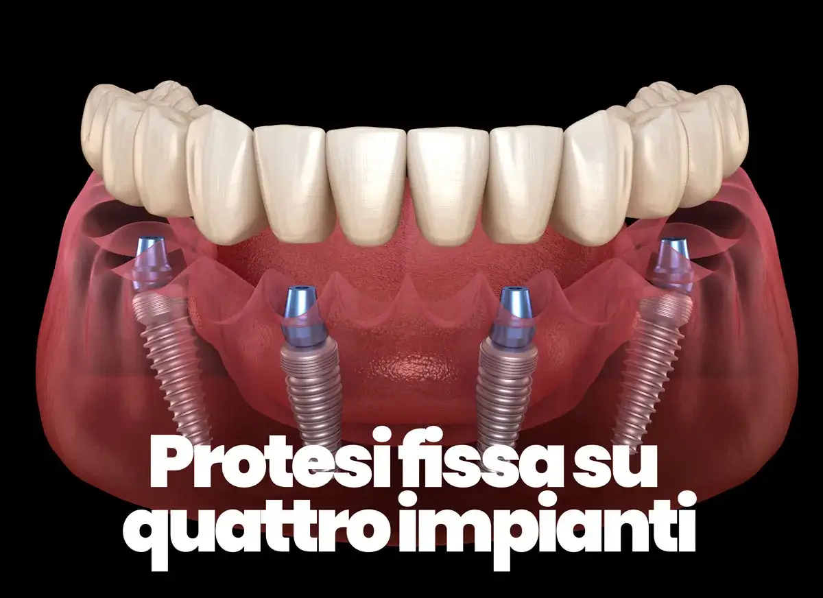 Protesi fissa su quattro impianti dentali, una soluzione per un sorriso completo e stabile.