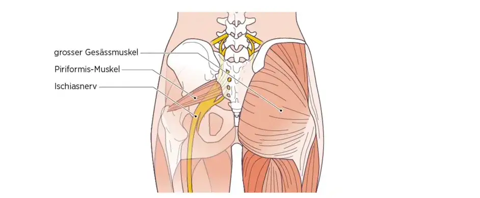 Anatomie eingeklemmter Nerv K&ouml;rperregionen