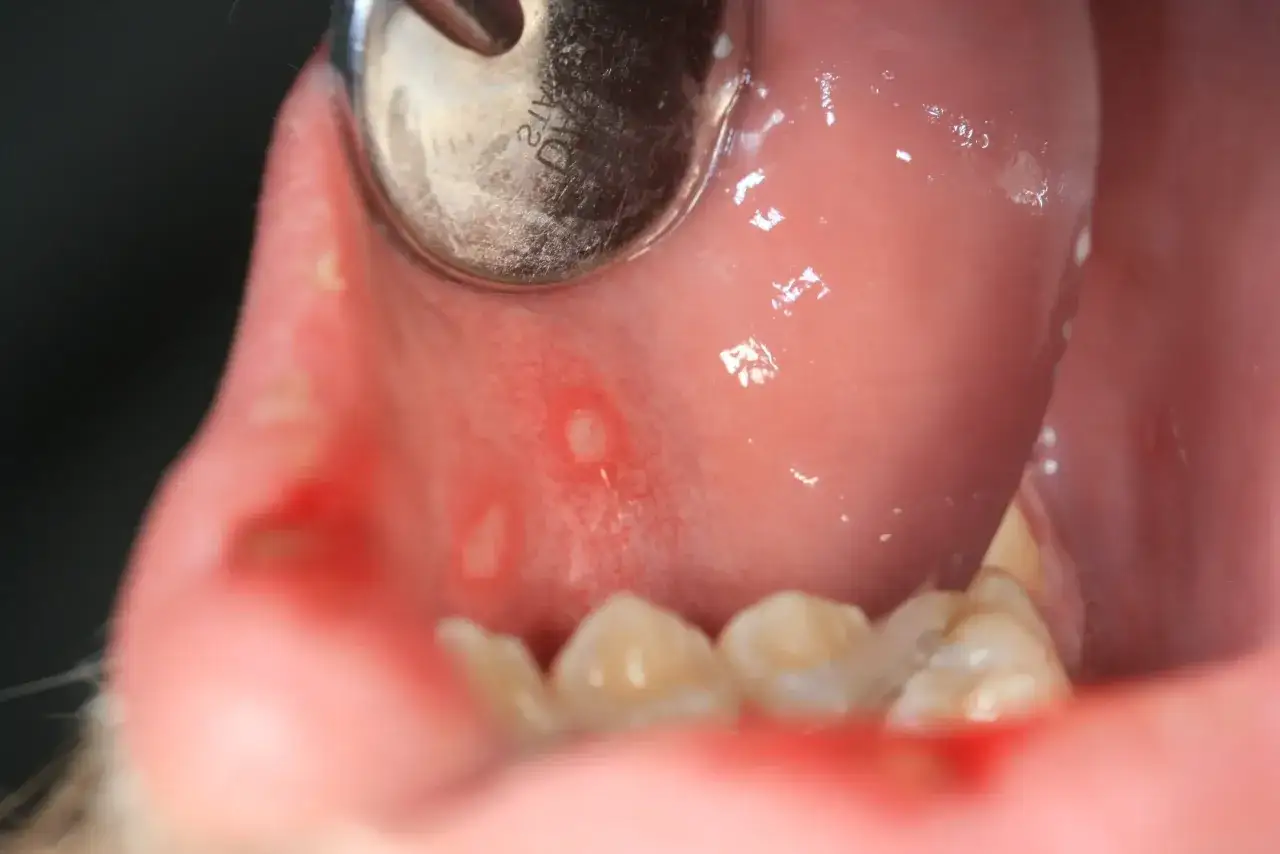 Mundhöhle mit roten Stellen und Bläschen, die auf Herpes Zunge hindeuten. Ein zahnärztliches Instrument ist sichtbar.