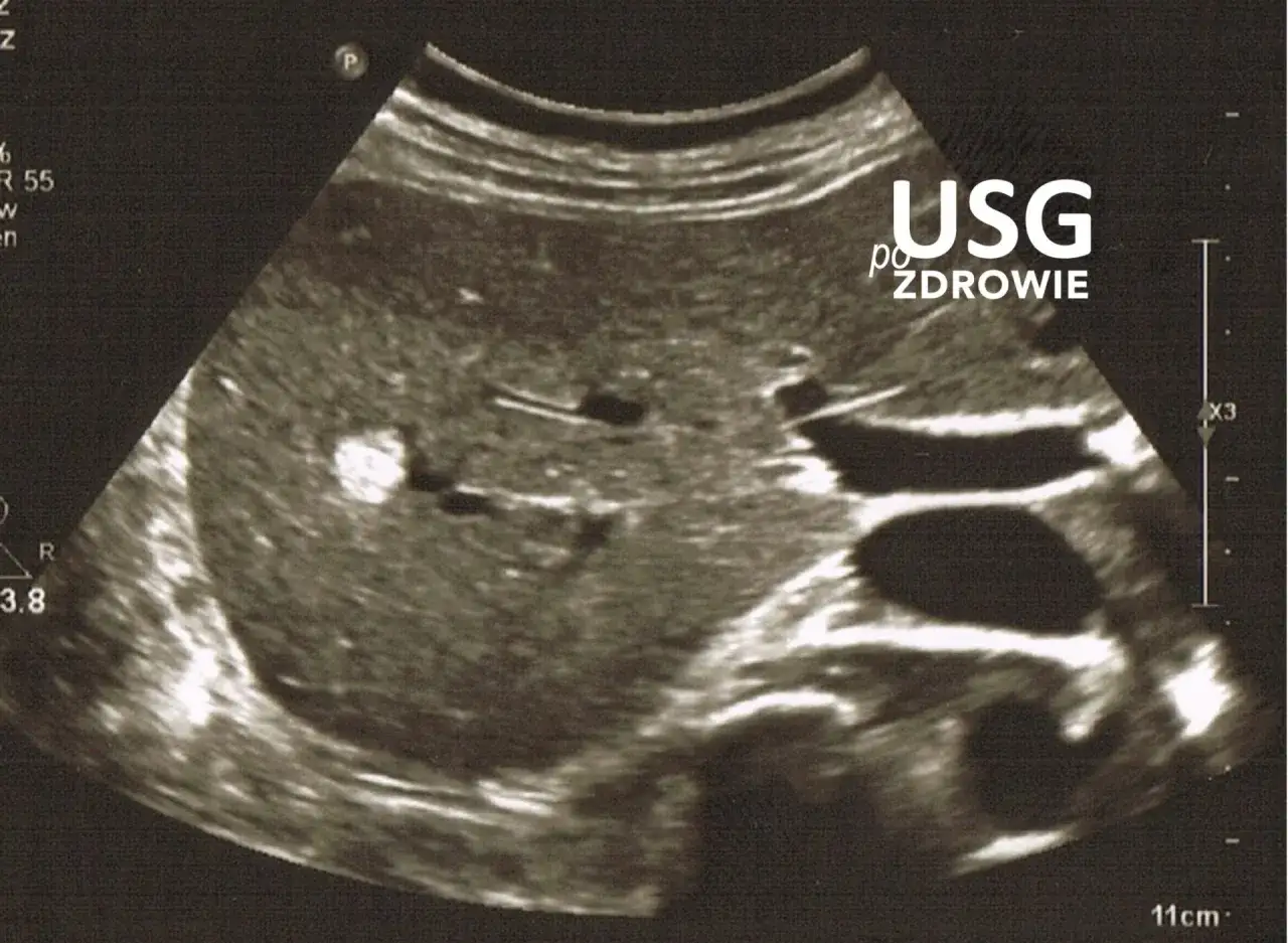 USG jamy brzusznej może wykryć zmiany, które mogą wskazywać na raka. Obraz przedstawia badanie USG narządów wewnętrznych.