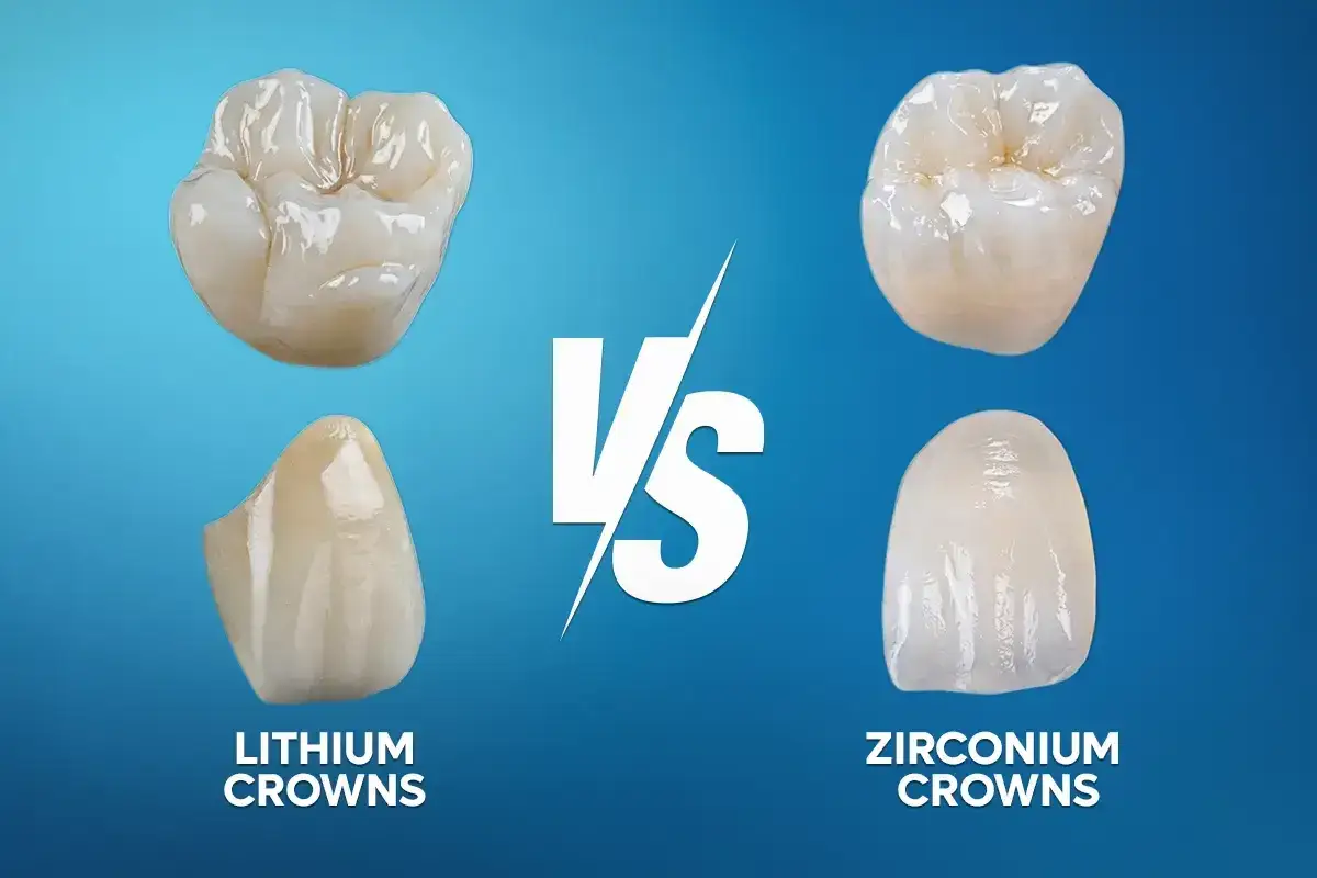 Comparaci&oacute;n de coronas dentales: coronas de disilicato de litio vs. coronas de zirconio.