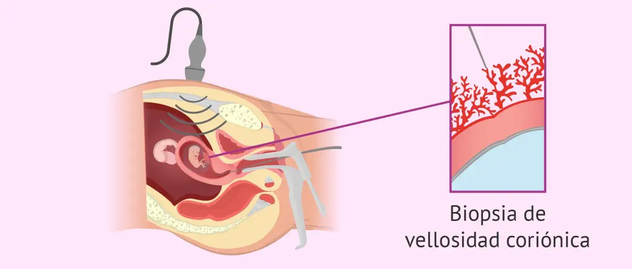 Ilustraci&oacute;n de una biopsia corial guiada por ultrasonido, mostrando la toma de muestra de vellosidades cori&oacute;nicas para an&aacute;lisis gen&eacute;tico.