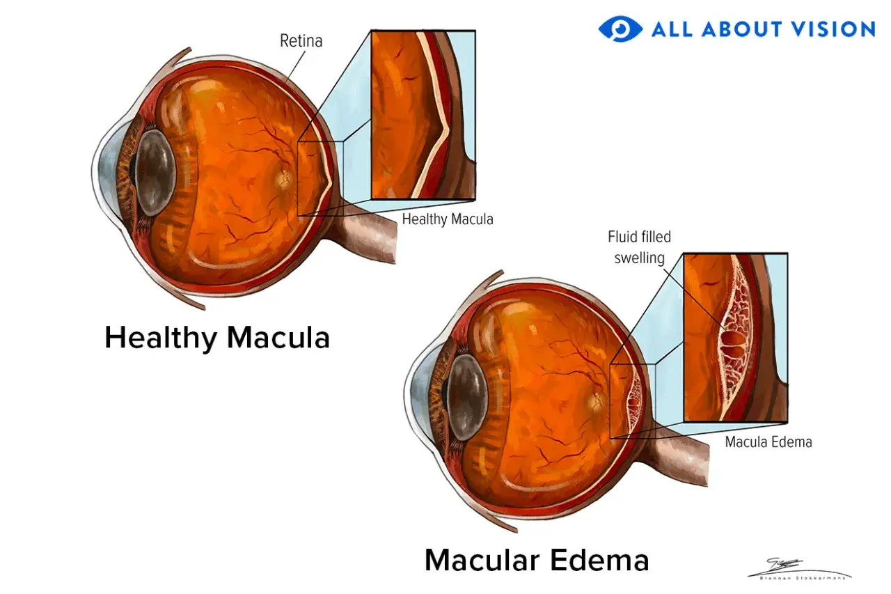 Confronto tra macula sana e macula edematosa, mostrando le cause dell'edema retinico con gonfiore pieno di liquido.
