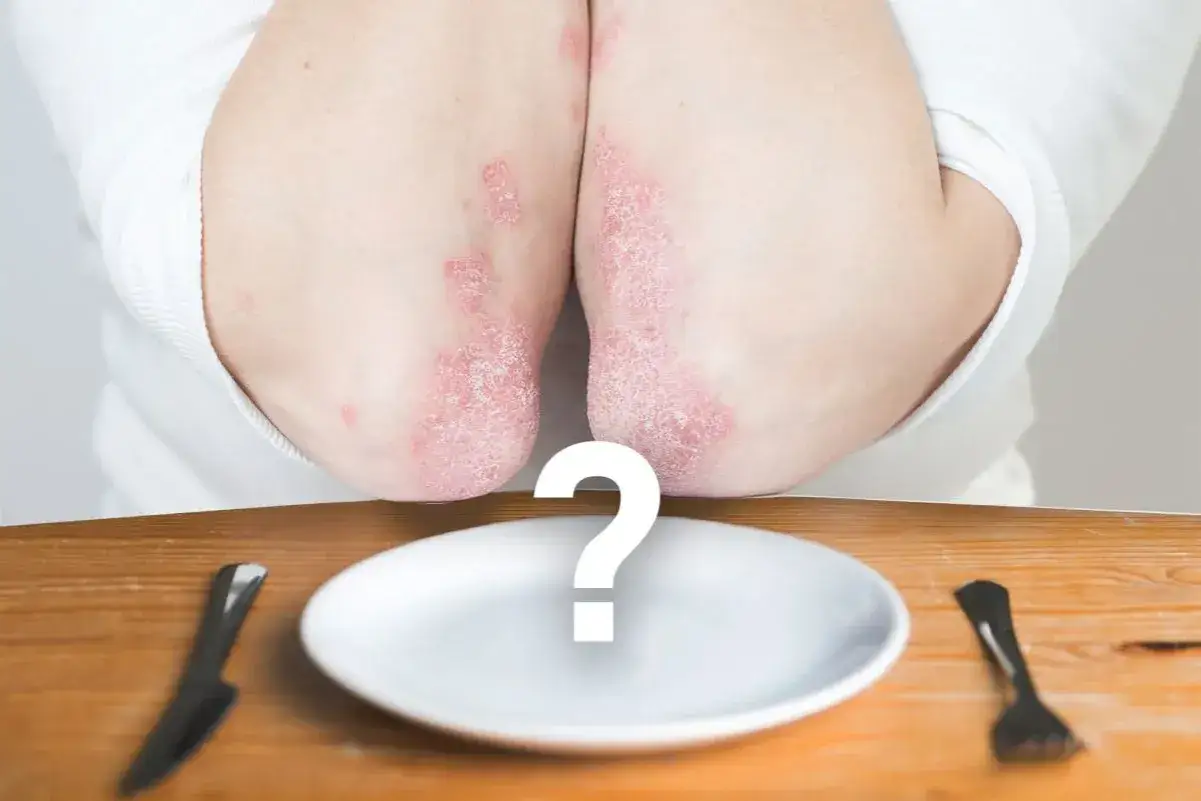 Łokcie z objawami artretyzmu, talerz i sztućce. Czy dieta pomoże?