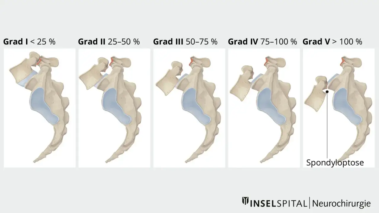 Illustrationen zeigen den Grad der Spondyloptose, von Grad I (<25%) bis Grad V (>100%), zur Beurteilung des Behinderungsgrades.