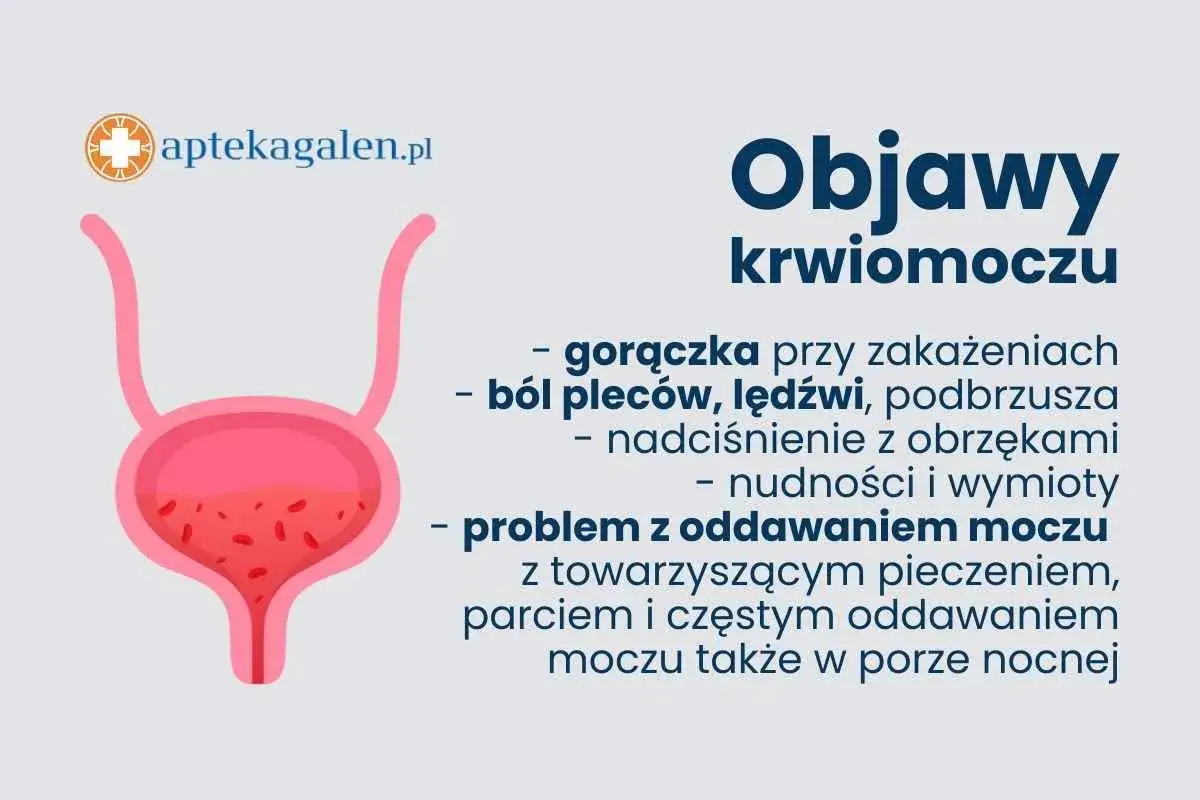 Grafika przedstawia pęcherz z widoczną krwią w moczu. Obok wypisano objawy krwiomoczu, m.in. ból pleców, nudności, problemy z oddawaniem moczu.