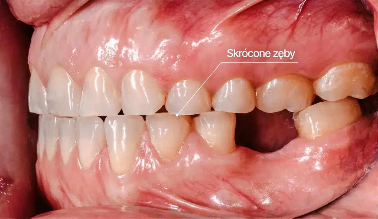 Skrócone zęby, widoczne na zbliżeniu jamy ustnej, to efekt zaniedbania higieny i potencjalnie używania narkotyków.