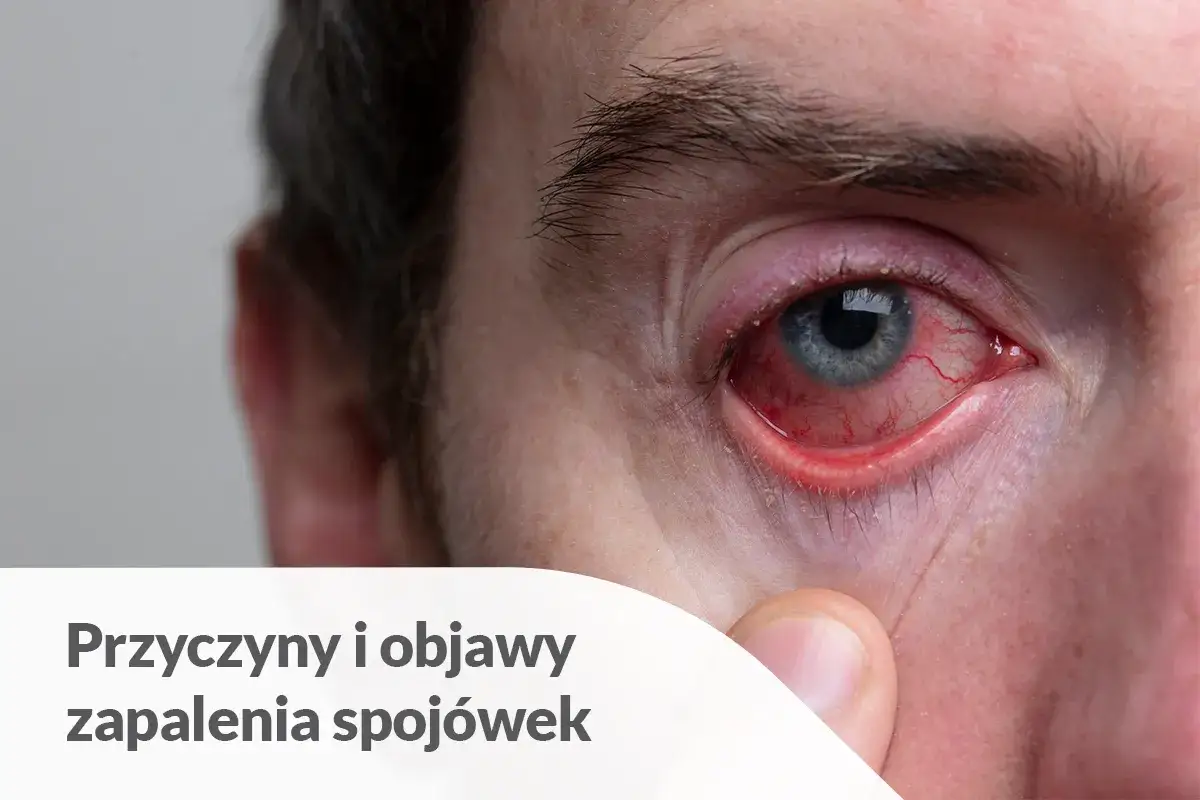 Silnie zaczerwienione oko z widocznymi naczynkami, objaw zapalenia spojówek.