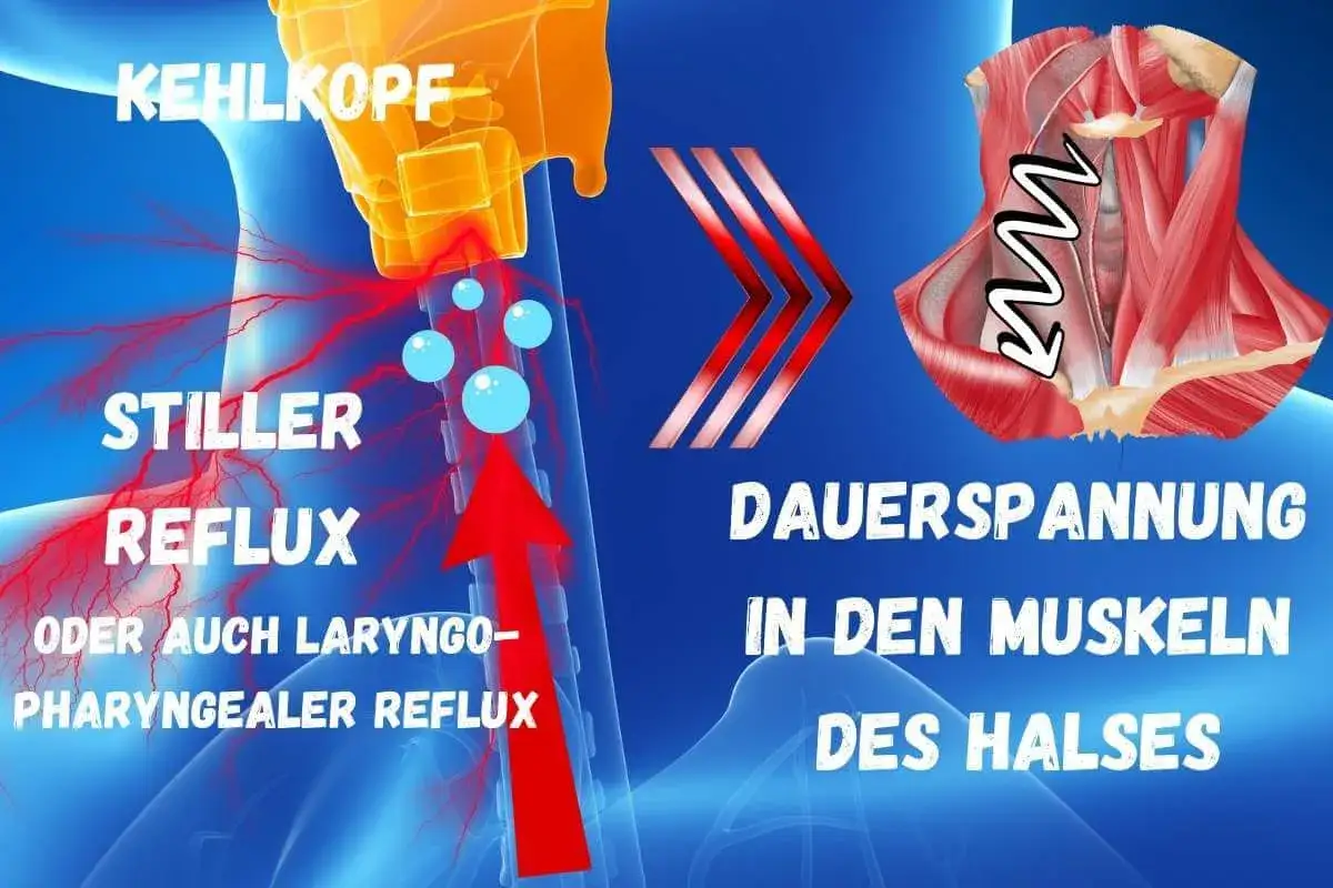 Stiller Reflux kann zu schluckbeschwerden durch verspannungen im Hals führen. Die Grafik zeigt den Kehlkopf und die Muskeln des Halses.