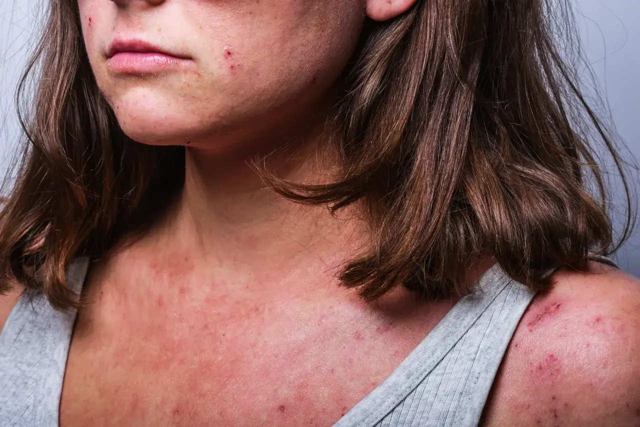 Frau mit geröteter, trockener Gesichtshaut, die sanft ihr Gesicht berührt