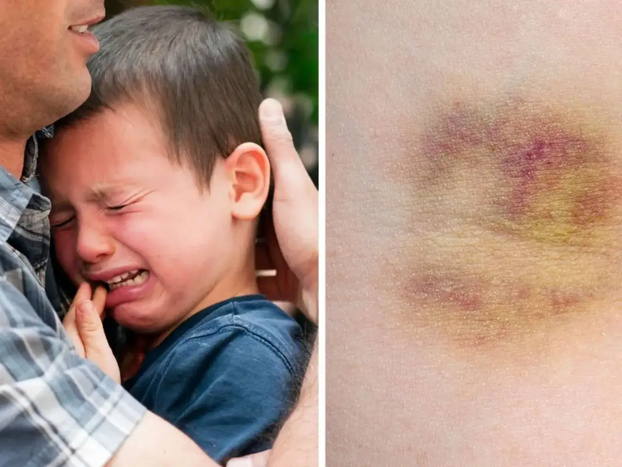 Ein weinendes Baby wird von einem Erwachsenen getr&ouml;stet. Daneben ein blauer Fleck, der an einen mongolenfleck baby erinnert.
