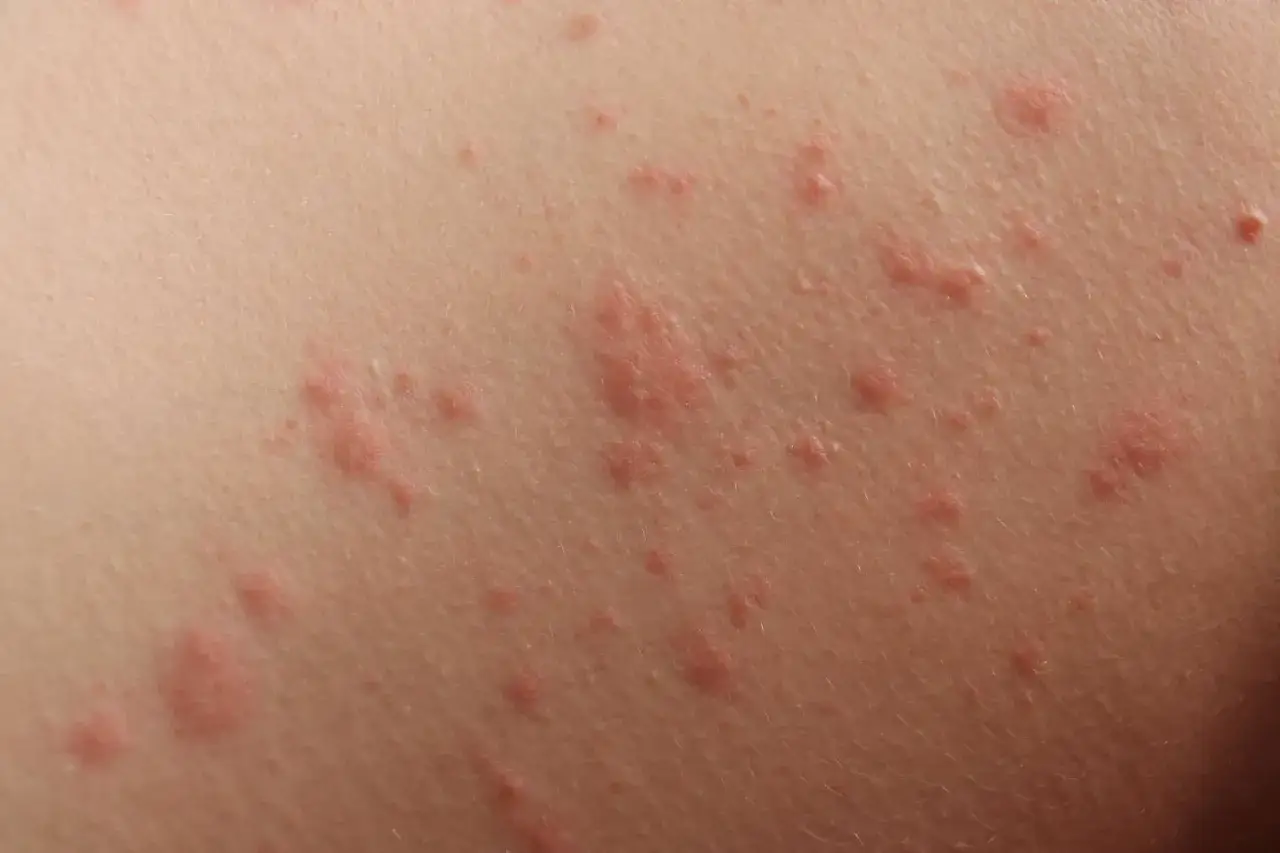 Immagini di orticaria nei bambini: eruzioni cutanee rosse e pruriginose sulla pelle chiara, alcune piccole e sparse, altre più grandi e raggruppate.