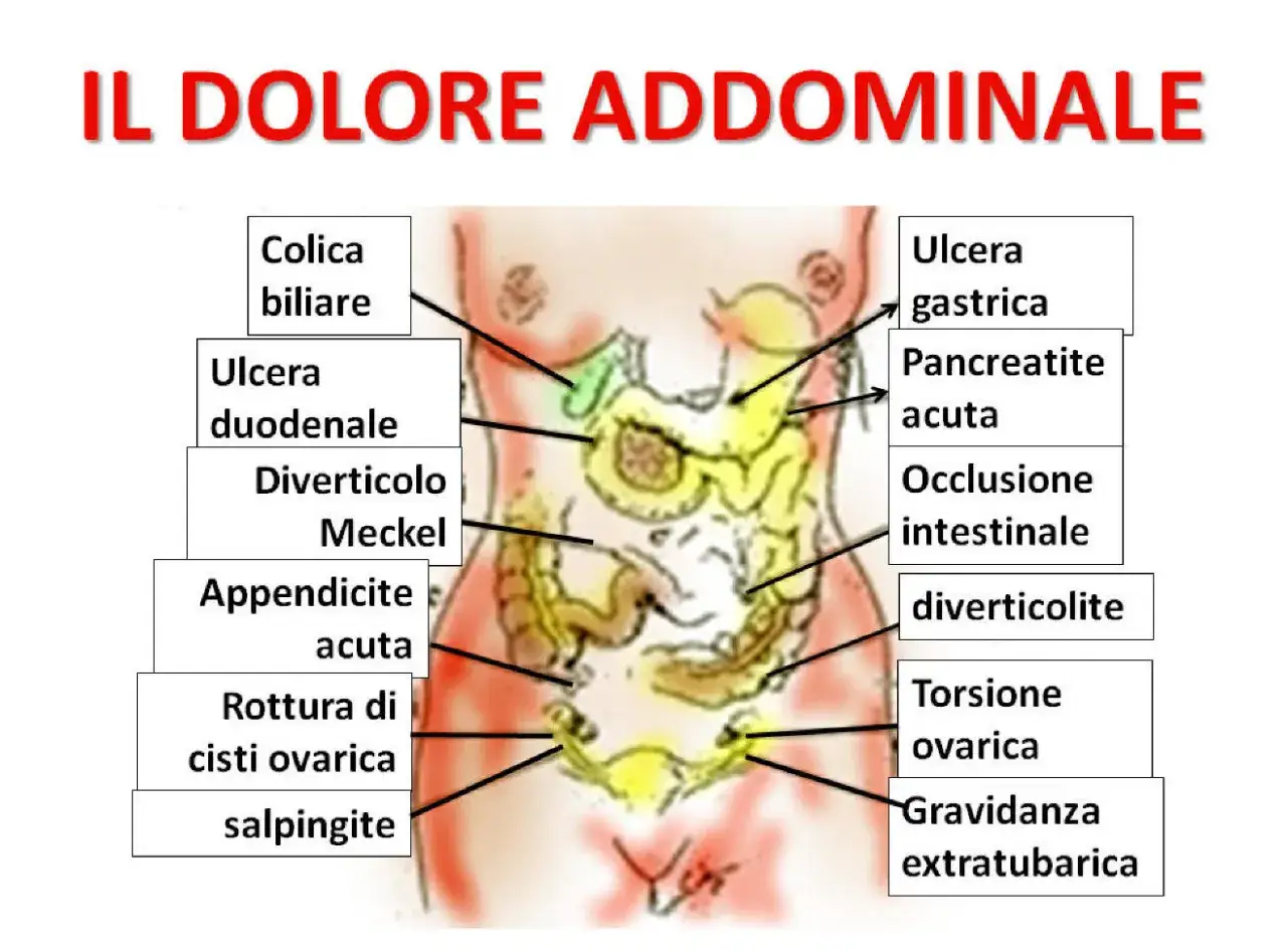 Illustrazione anatomica del torso umano che mostra le cause del mal di pancia dopo mangiato, come colica biliare, ulcere e appendicite.