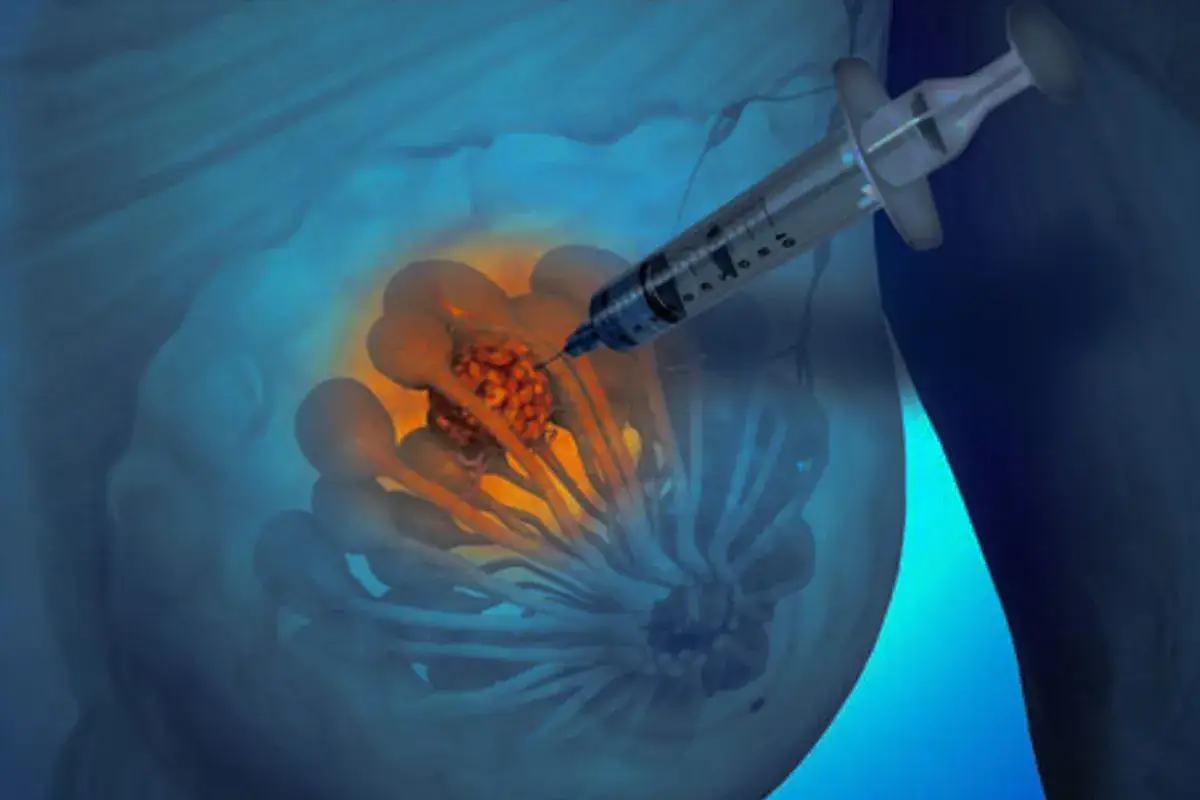 Darstellung einer Biopsie mit einer Spritze, die in einen Tumor in der Brust eindringt. Mögliche verschleppung von krebszellen durch biopsie wird thematisiert.
