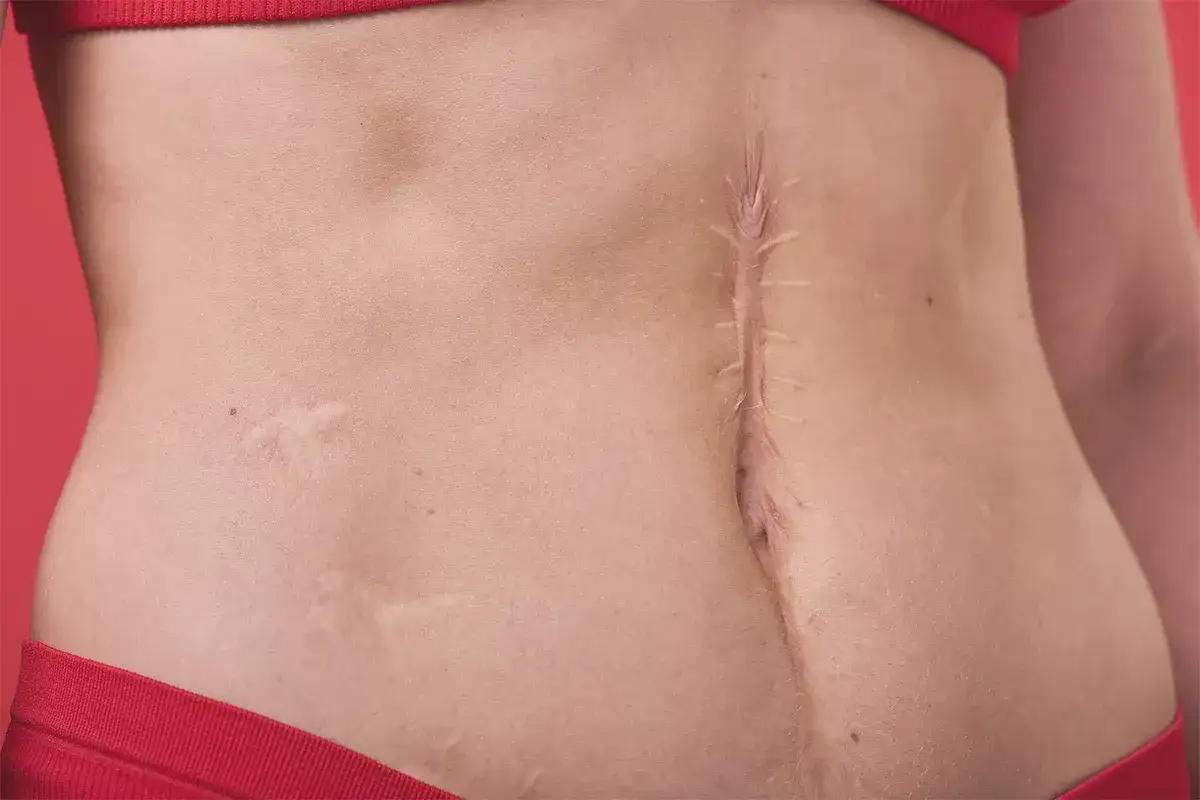 Addome con cicatrice chirurgica verticale. Un esempio di danno estetico, utile per consultare tabelle risarcimento danno estetico.