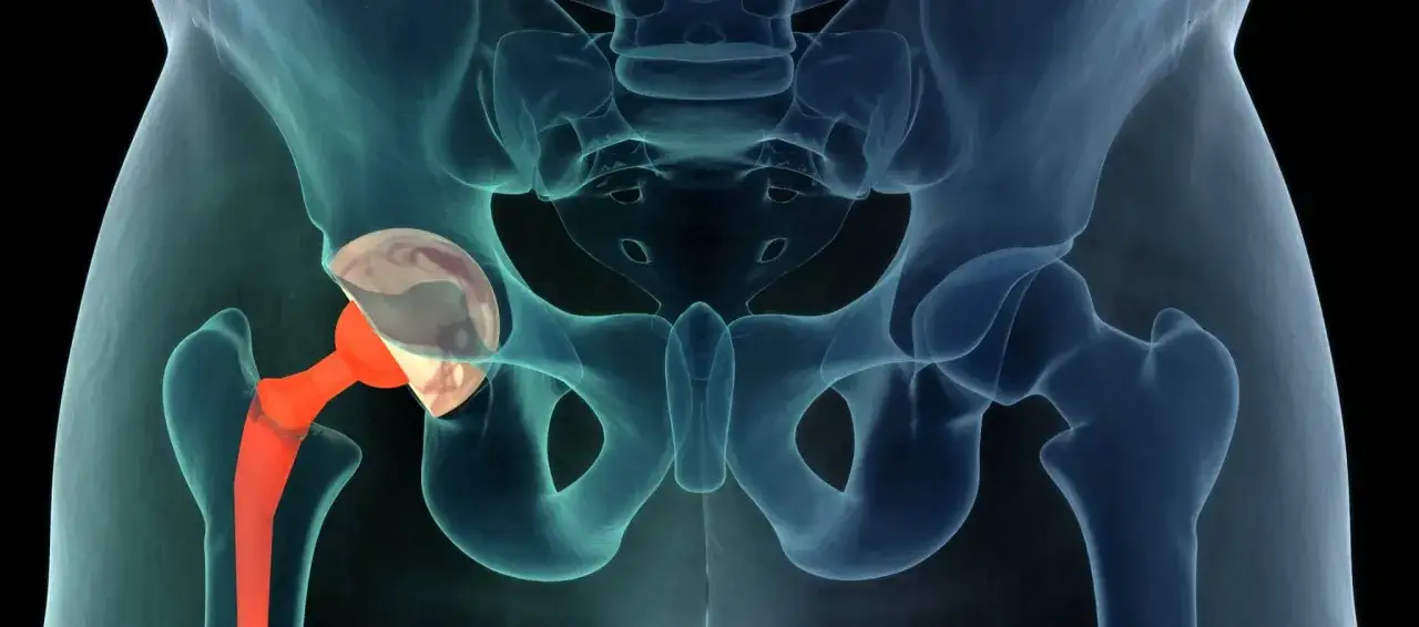 Anatomie du bassin avec une proth&egrave;se de hanche rouge. Apr&egrave;s 10 ans, une douleur peut survenir.