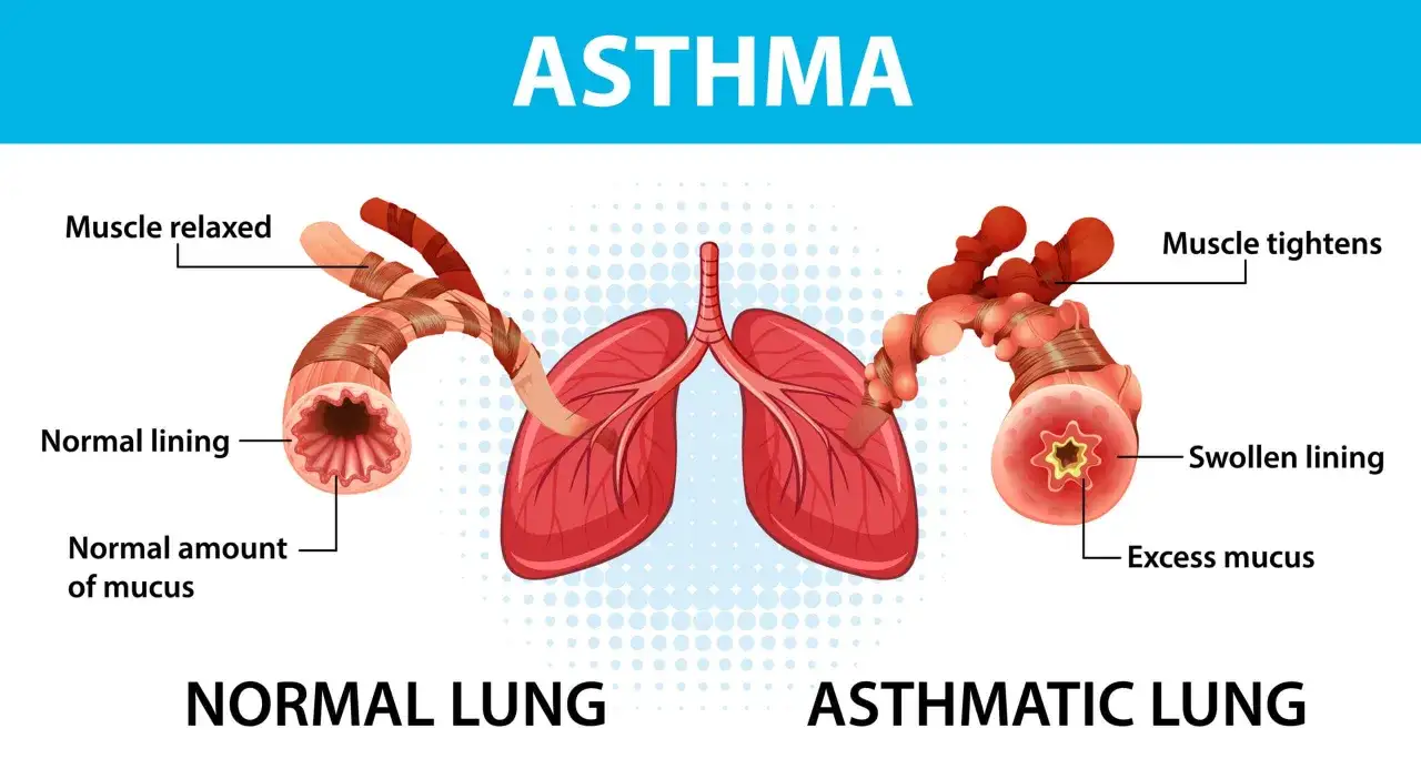 Vergleich von Lunge und Bronchien: Normale Lunge mit entspannten Muskeln und normalem Schleim vs. asthmatische Lunge mit verkrampften Muskeln, geschwollener Schleimhaut und &uuml;berm&auml;&szlig;igem Schleim.
