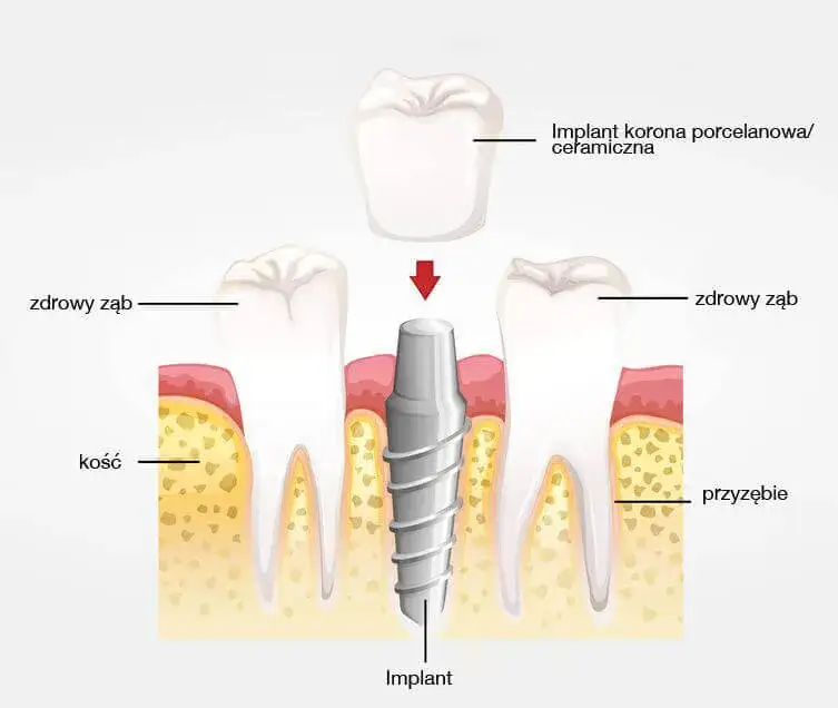 Cennik implantów zębowych w Polsce infografika