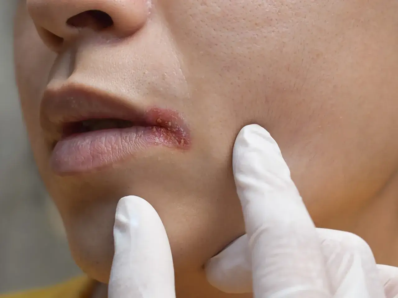 Nahaufnahme eines Mundes mit Lippenherpes. Ein Arzt in Handschuhen untersucht die Stelle, was auf eine m&ouml;gliche Mundrose Therapie hindeutet.
