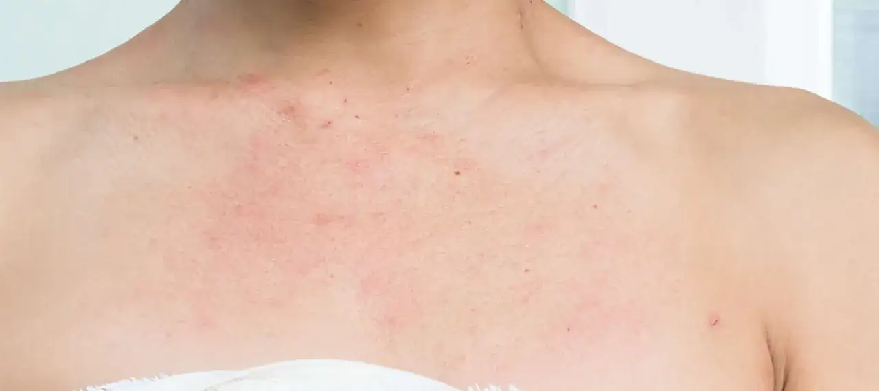 Poitrine et cou rougis, signes de dermatite atopique aggrav&eacute;e par la transpiration.