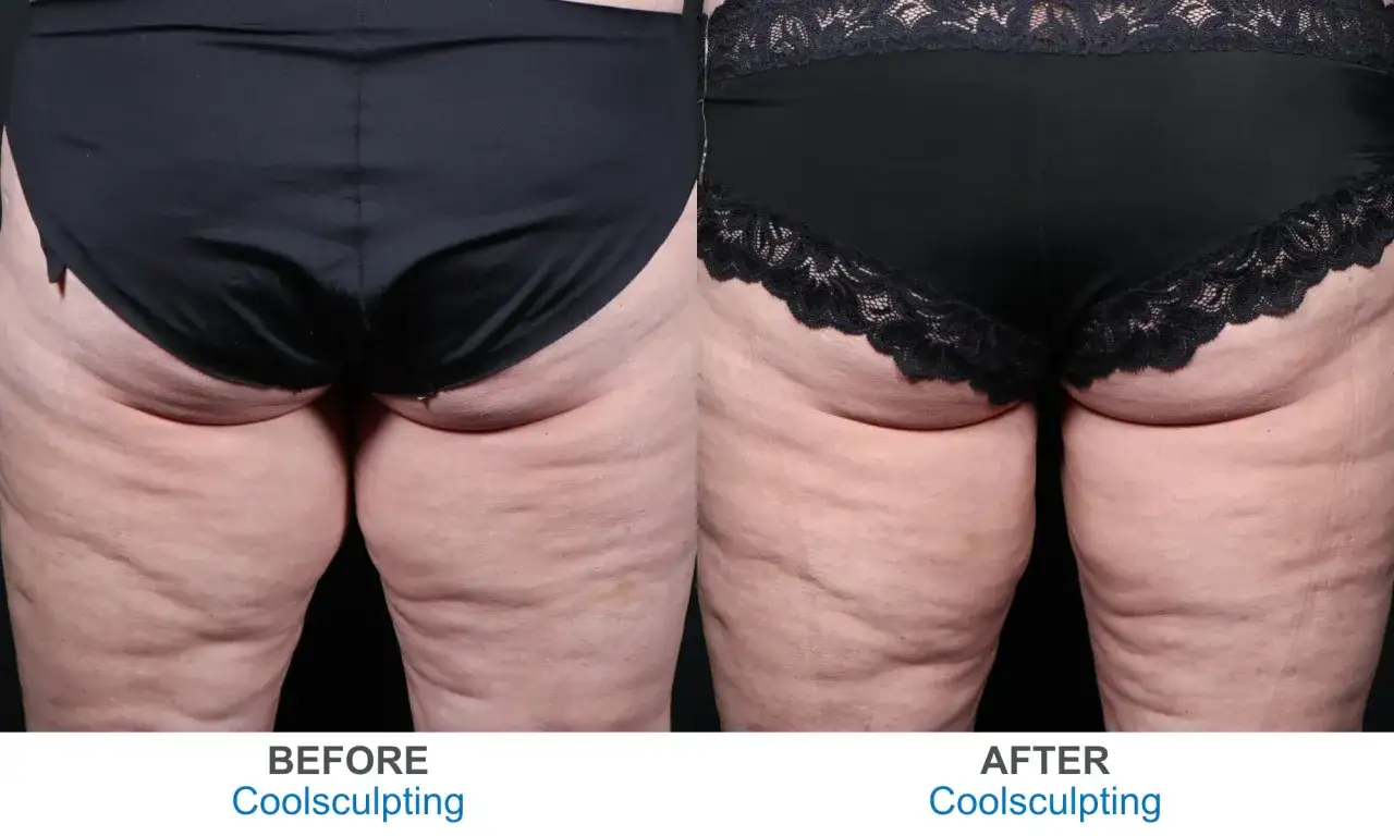 Porównanie ud przed i po zabiegu CoolSculpting. Widoczne pozytywne kriolipoliza efekty uda, skóra jest gładsza.