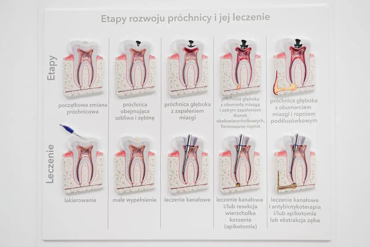 Model przedstawia etapy rozwoju próchnicy i jej leczenie. Widać, jak narzędzia stomatologiczne są używane do oczyszczania zęba, co pomaga w usuwaniu tego, co wyciąga ropę z zęba.