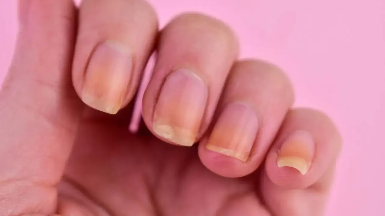 Gros plan sur une main montrant plusieurs ongles jaunis, certains pr&eacute;sentant des d&eacute;colorations et des irr&eacute;gularit&eacute;s.