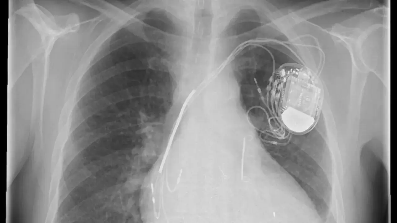 Radiographie thoracique montrant un défibrillateur cardiaque implanté avec ses sondes dans le cœur.