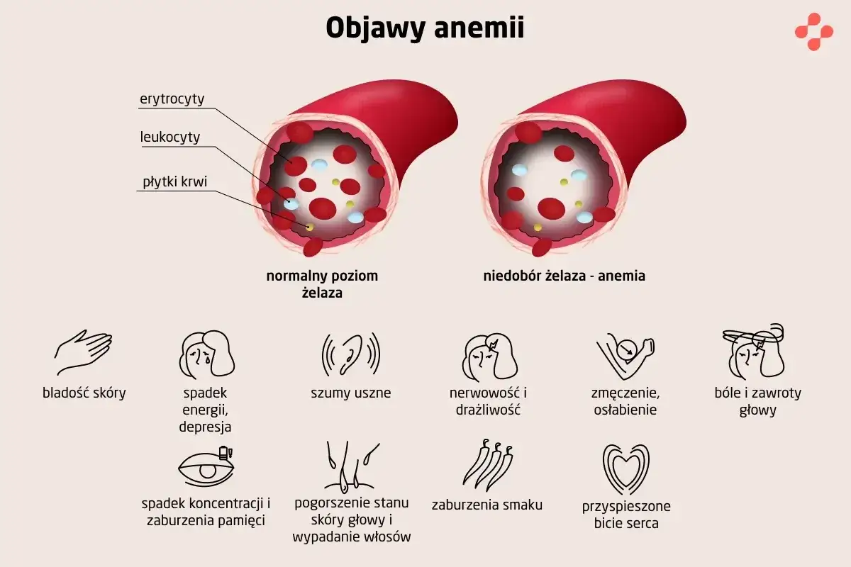 Ilustracja porównuje naczynia krwionośne z normalnym poziomem żelaza i niedoborem żelaza (anemia), pokazując objawy takie jak bladość skóry, zmęczenie i bóle głowy.