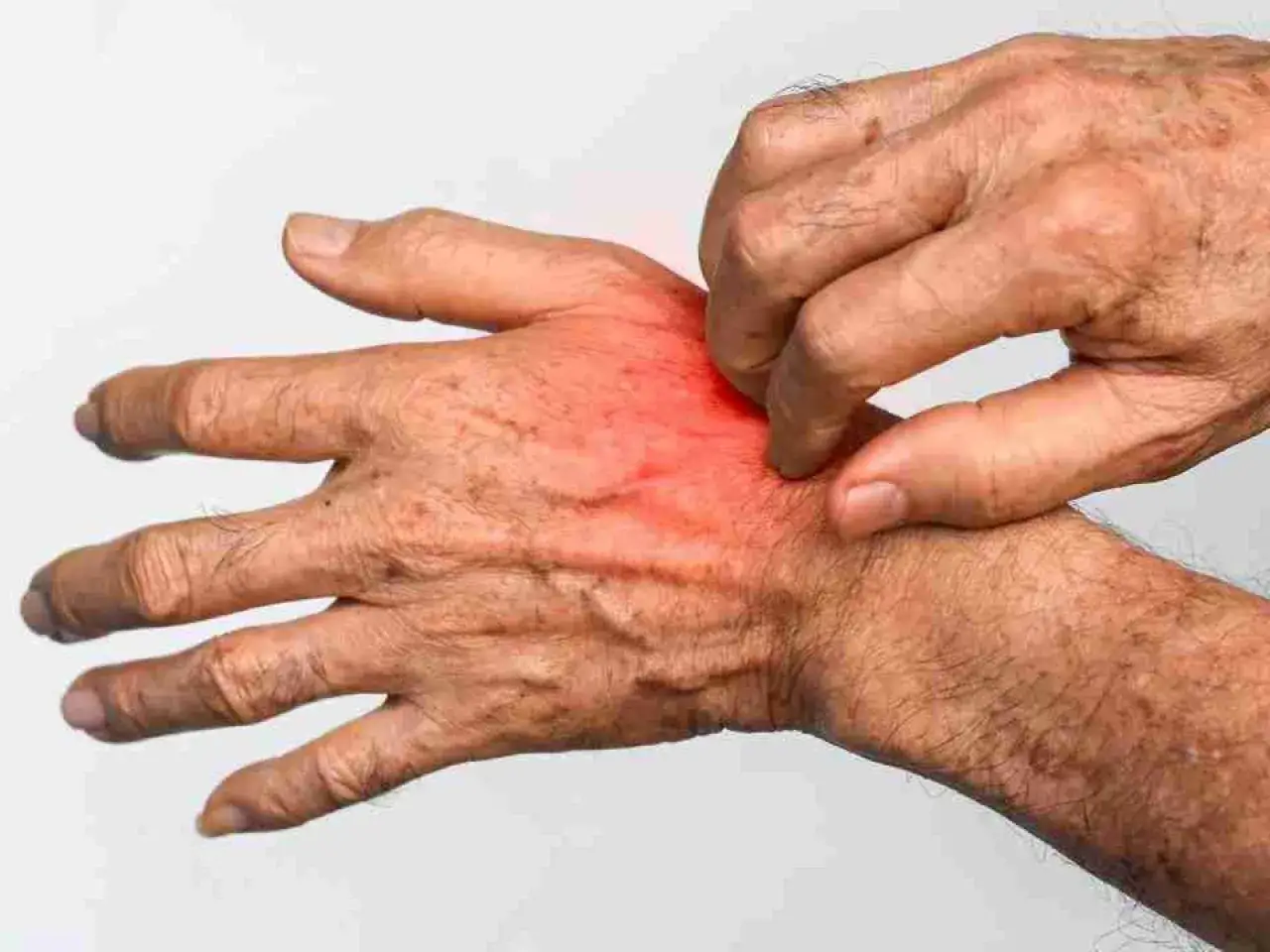 Mano anziana con arrossamento e prurito, segnali di inizio scabbia.