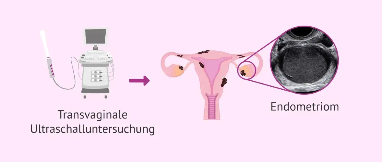 Transvaginale Ultraschalluntersuchung zeigt ein Endometriom.