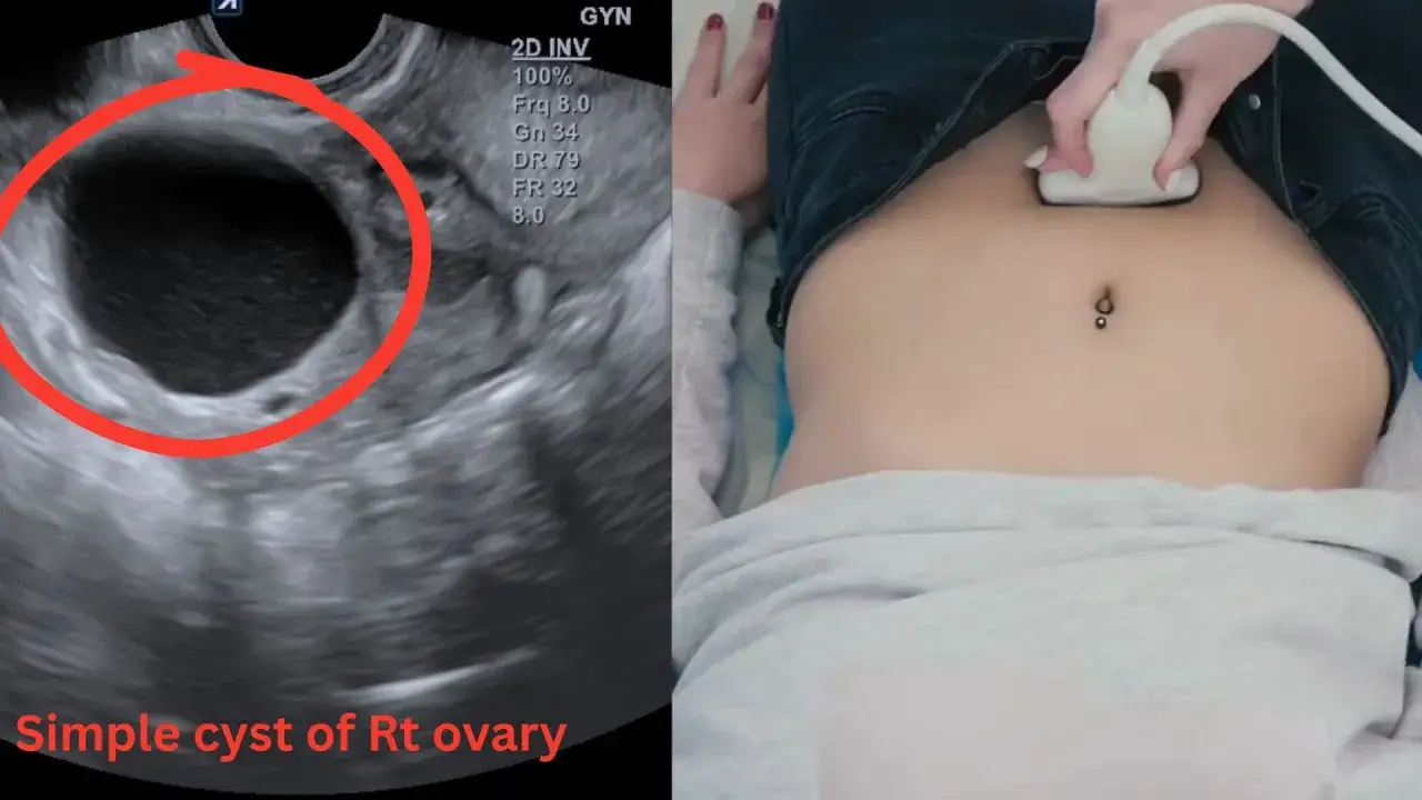 Obraz USG pokazuje torbiel na jajniku, widoczną w czerwonym okręgu. Obok badanie ultrasonograficzne brzucha.
