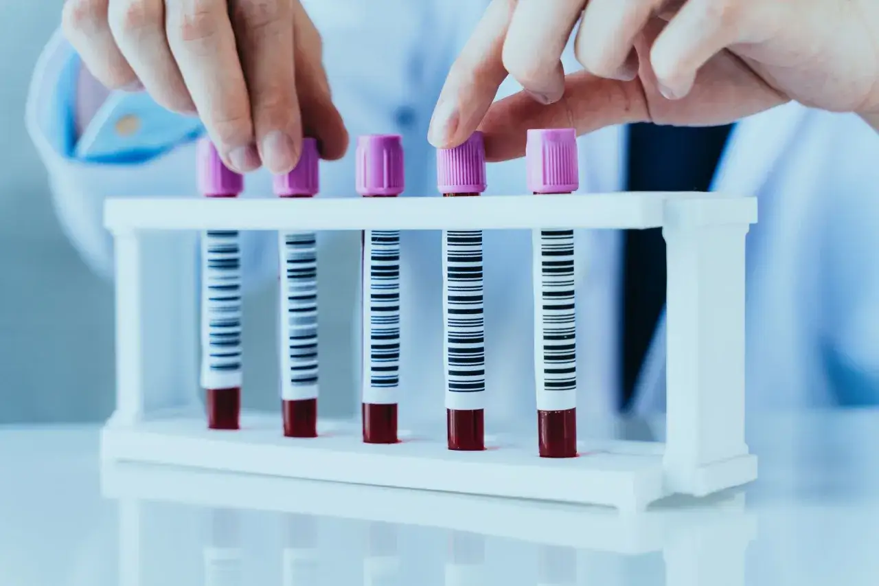 Ręce laboratoryjne umieszczają probówki z krwią w stojaku. Wyniki analizy wskazują, że rdw-sd powyżej normy.