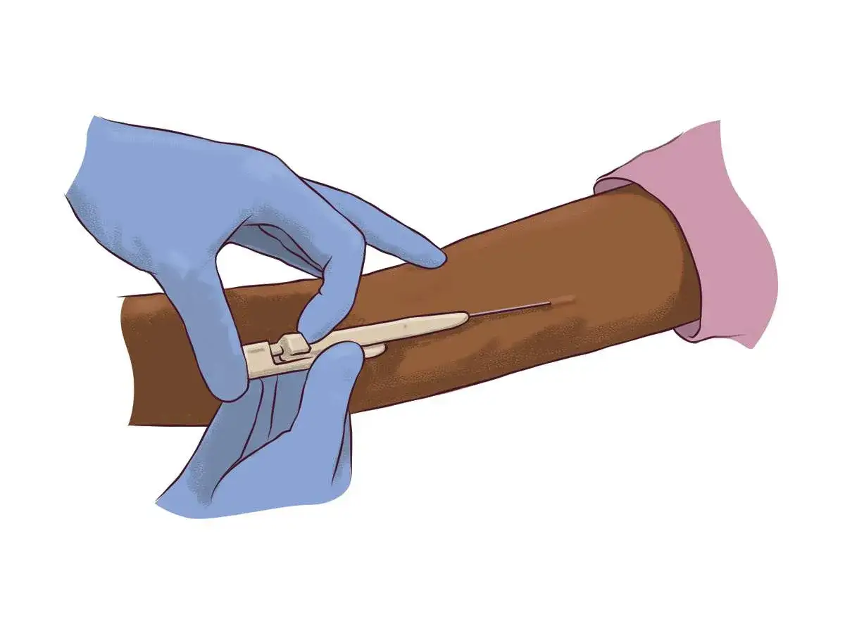 Manos enguantadas insertan un implante anticonceptivo en el brazo.
