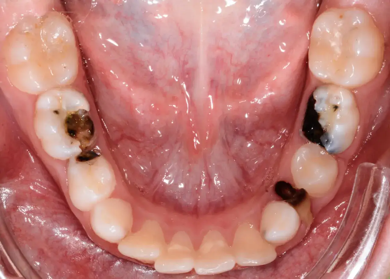 Denti da latte con carie avanzata, alcuni con otturazioni scure.