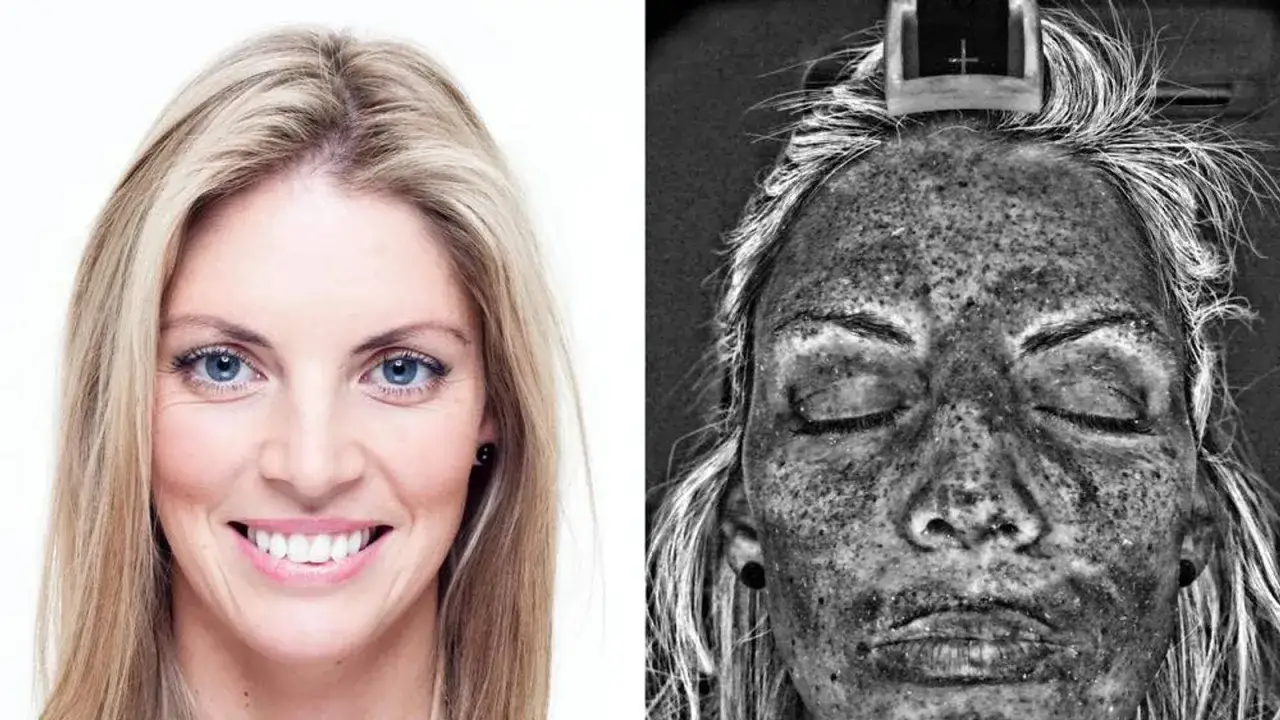 Por&oacute;wnanie sk&oacute;ry: po lewej zdrowa, po prawej pod lampą UV, uwidaczniającą skutki opalania, np. z solarium. Retinol może pom&oacute;c w regeneracji.