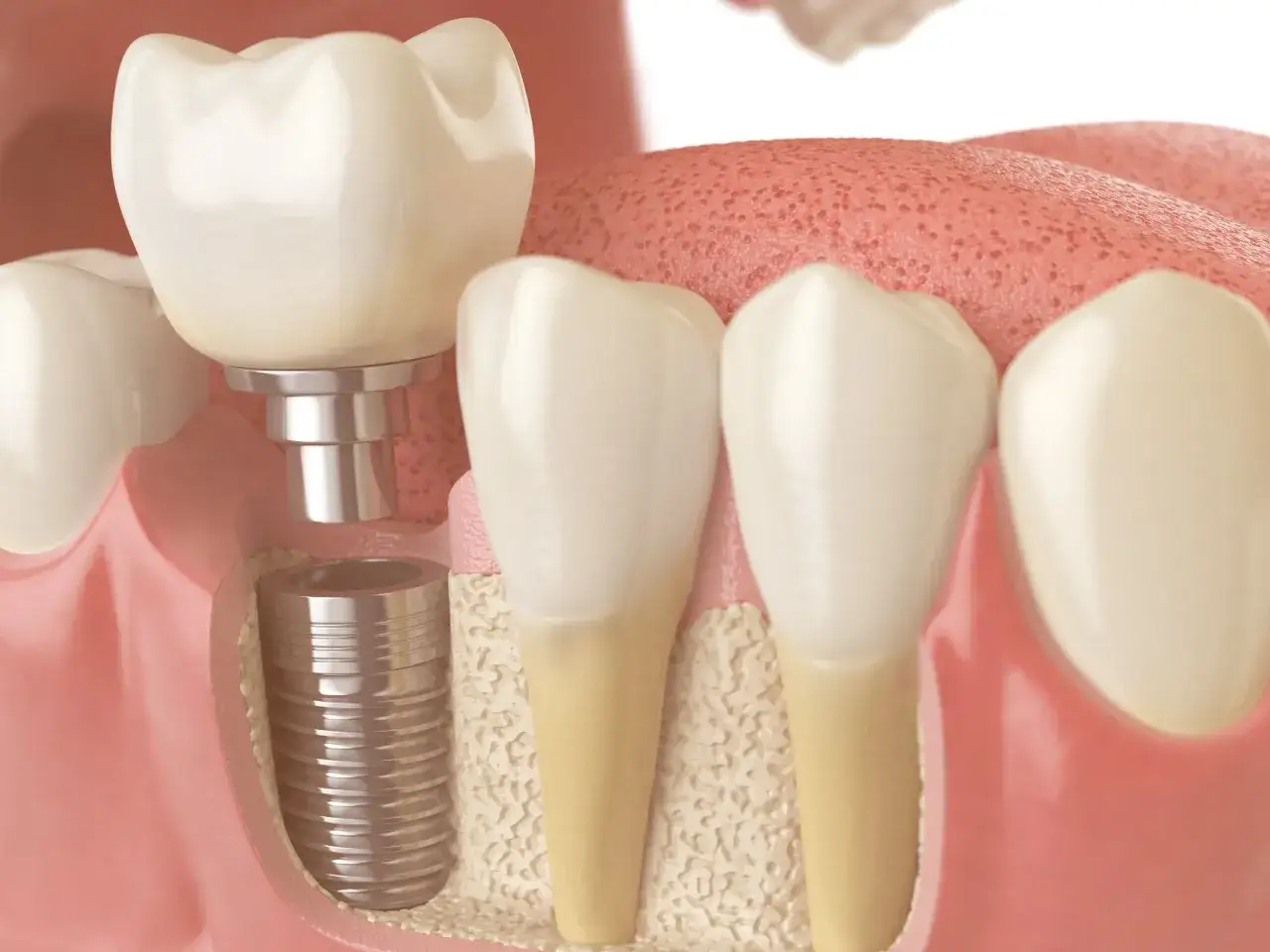 Implante dental en proceso de integración con el hueso maxilofacial. Se observa el tornillo implantado y la corona dental lista para ser colocada.